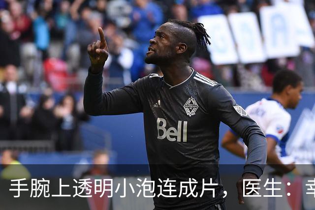 手腕上透明小泡连成片，医生：幸好没弄到眼睛里